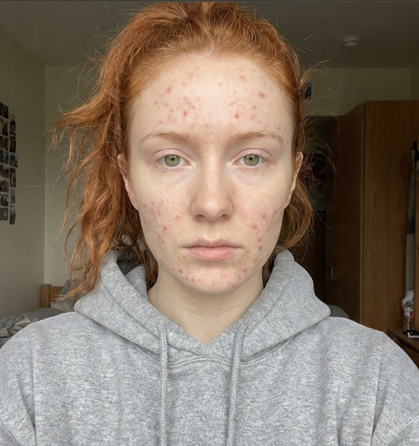 Before — Emma